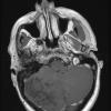 2A3 Lhermitte-Duclos (Case 2) T1W 1 - Copy