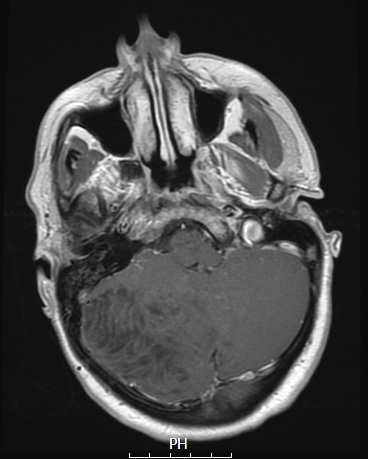 2A3 Lhermitte-Duclos (Case 2) T1W 1 - Copy