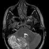 2A4 Lhermitte-Duclos (Case 2) T2 1 - Copy