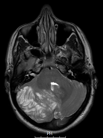 2A4 Lhermitte-Duclos (Case 2) T2 1 - Copy