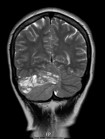 2A5 Lhermitte-Duclos (Case 2) T2 COR - Copy