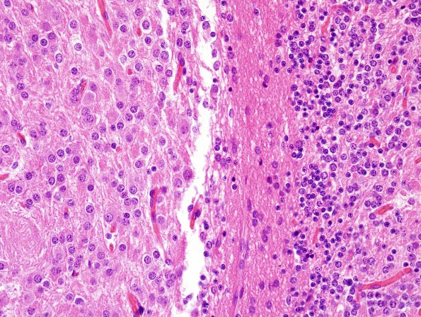 2B10 Lhermitte-Duclos (Case 2) H&E 5.jpg