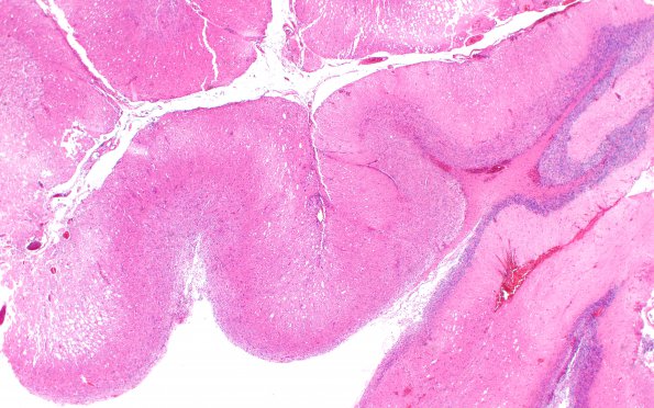 2B11 Lhermitte-Duclos (Case 2) B3 H&E 2X