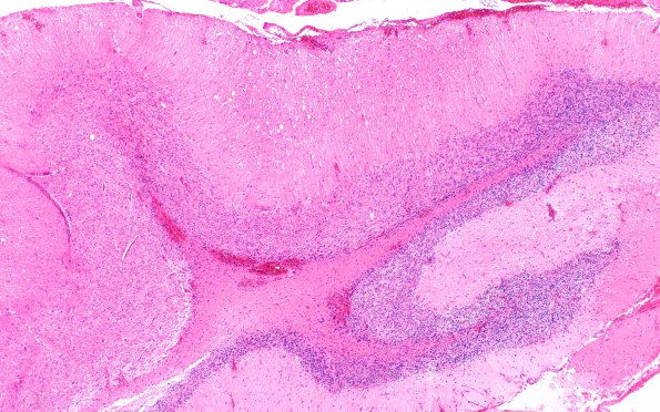 2B12 Lhermitte-Duclos (Case 2) B3 H&E 4X