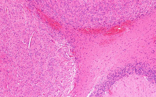 2B13 Lhermitte-Duclos (Case 2) B3 H&E 10X