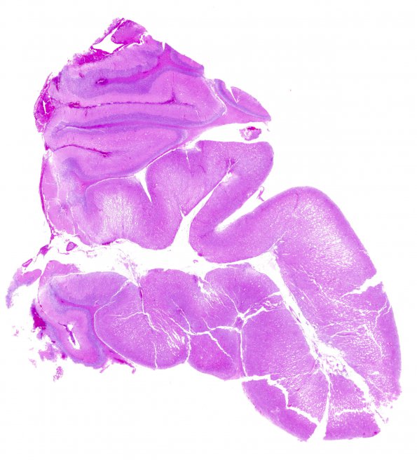 2B14 Lhermitte-Duclos (Case 2) H&E A4 whole mount