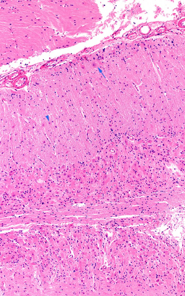 2B5 Lhermitte-Duclos (Case 2) C5 H&E 10X copy