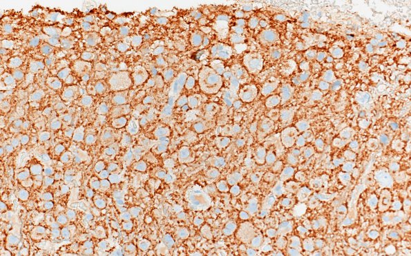 2C2 Lhermitte-Duclos (Case 2) A4 Area A SYN 40X