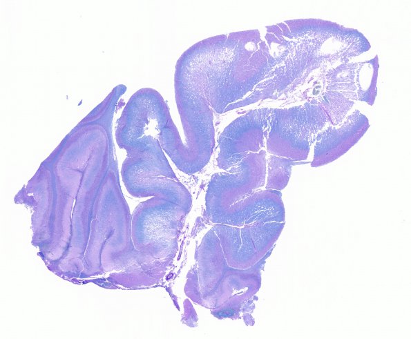 2F1 Lhermitte-Duclos (Case 2) B4 LFB-PAS whole mount