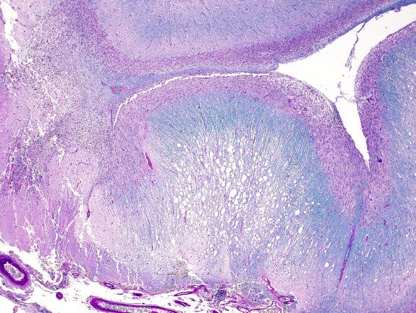 2F4 Lhermitte-Duclos (Case 2) B4 LFB-PAS 4.jpg