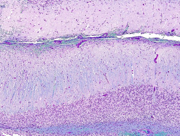 2F5 Lhermitte-Duclos (Case 2) B4 LFB-PAS 5.jpg