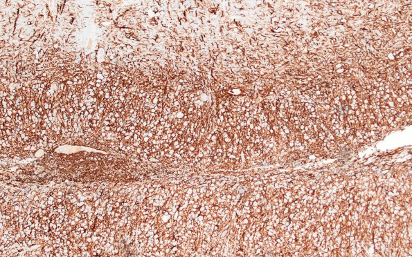 2H1 Lhermitte-Duclos (Case 2) A4 Area A GFAP 10X