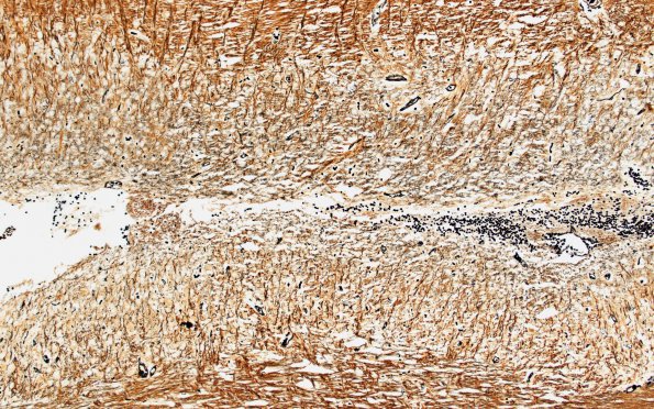 2I1 Lhermitte-Duclos (Case 2) B4 Biels 10x