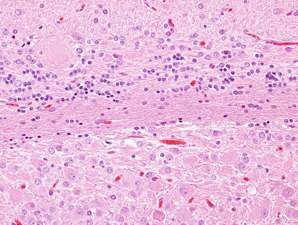 3A4 Lhermitte-Duclos Dz (Case 3) H&E 1
