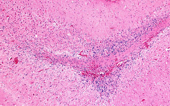 3A5 Lhermitte-Duclos Dz (Case 3) H&E 10X