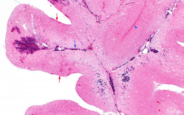 4A2 Lhermitte-Duclos (Case 4) H&E 2X labeled copy