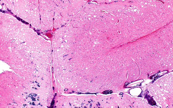 4A3 Lhermitte-Duclos (Case 4) H&E 4X