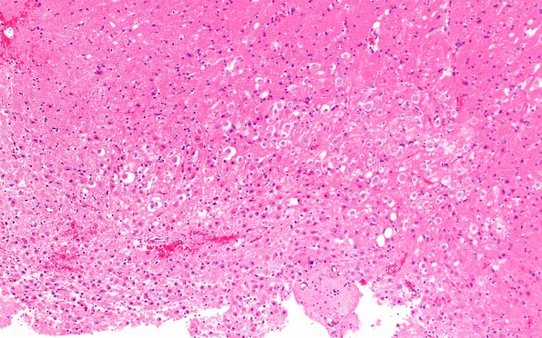 5A2 Lhermitte-Duclos Dz (Case 5) H&E 10X 1