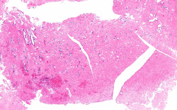 5A4 Lhermitte-Duclos Dz (Case 5) H&E 40X 1