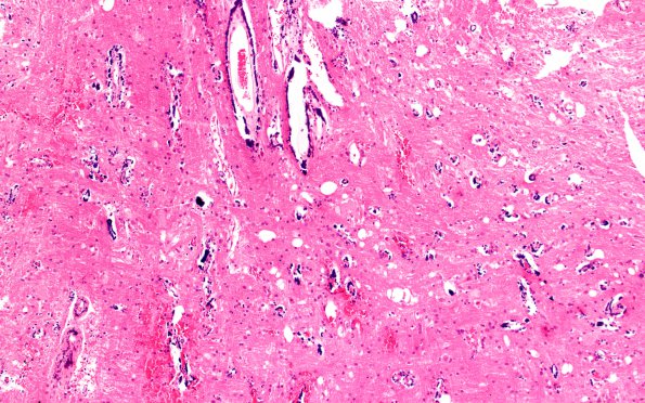 5A5 Lhermitte-Duclos Dz (Case 5) H&E 10X mol layer