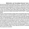 0A Multinodular & Vacuolating Neuronal Tumor - Text