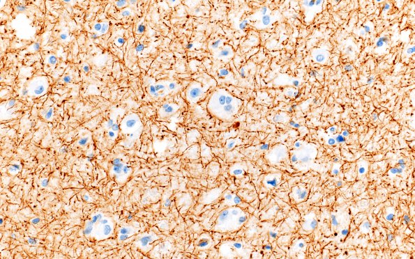 1E4 MVNT (Case 1) B3 NF 40X