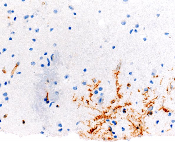 1F MVNT (Case 1) B3 CD34 40X