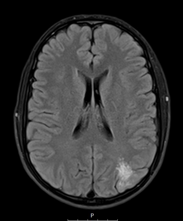 2A1 MVNT (Case 2) FLAIR - Copy