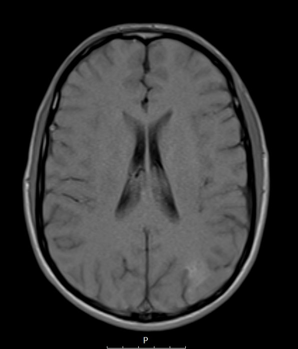 2A2 MVNT (Case 2) T1noC - Copy