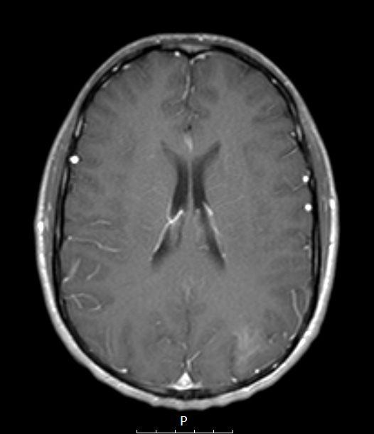 2A3 MVNT (Case 2) T1W - Copy