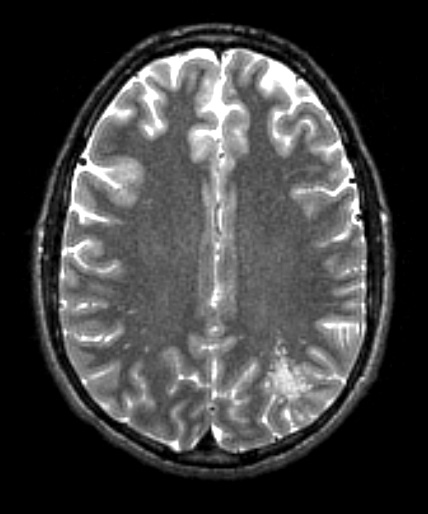 2A4 MVNT (Case 2) T2W - Copy