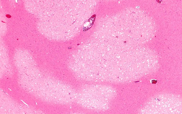 2B3 MVNT (Case 2) B2 H&E 4X 1 A