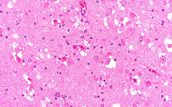 2B6 MVNT (Case 2) B2 H&E 40X 1