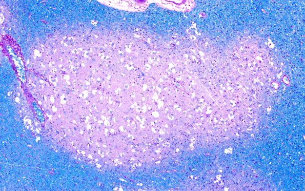 2C2 MVNT (Case 2) B3 LFB-PAS 10X 2