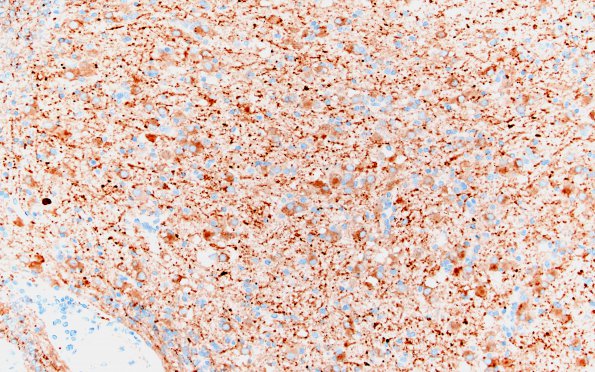 2E4 MVNT (Case 2) B3 SYN 20X