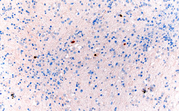 2G2 MVNT (Case 2) B3 NeuN 20X 3