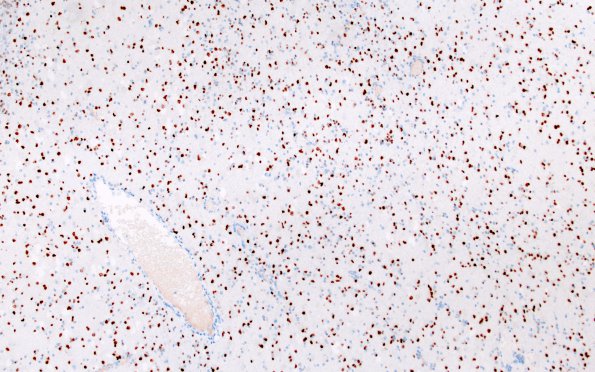 2I MVNT (Case 2) B3 Olig2 10X 2