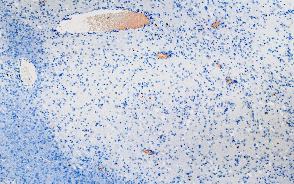 2J MVNT (Case 2) B3 Ki67 10X 2