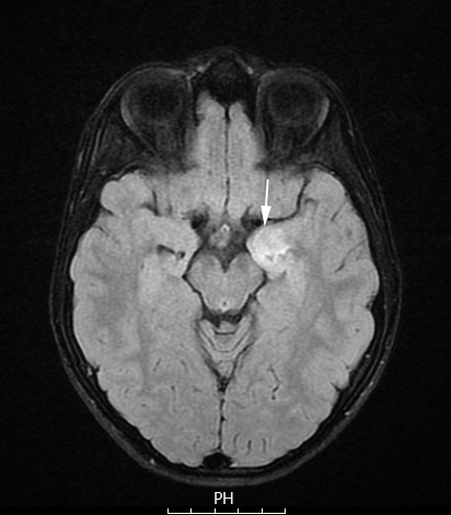 3A1 MVNT (Case 3) T2 FLAIR copy - Copy