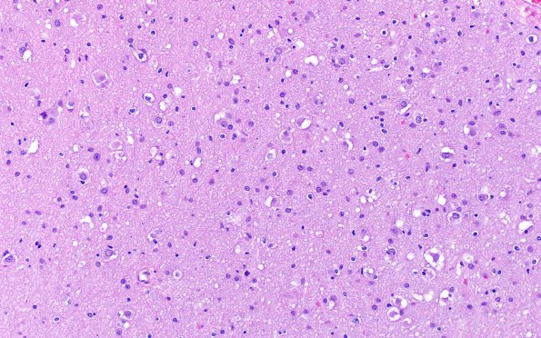 3B1 MVNT (Case 3) B6 H&E 20X 1