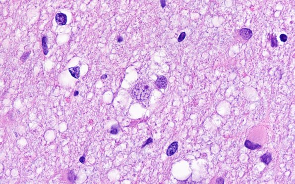 3B10 MVNT (Case 3) H&E 100X 3