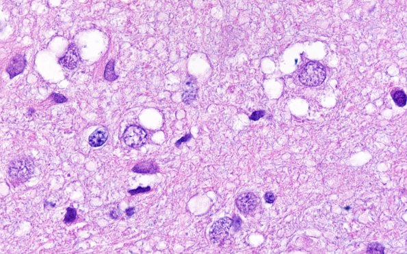 3B11 MVNT (Case 3) H&E 100X 5