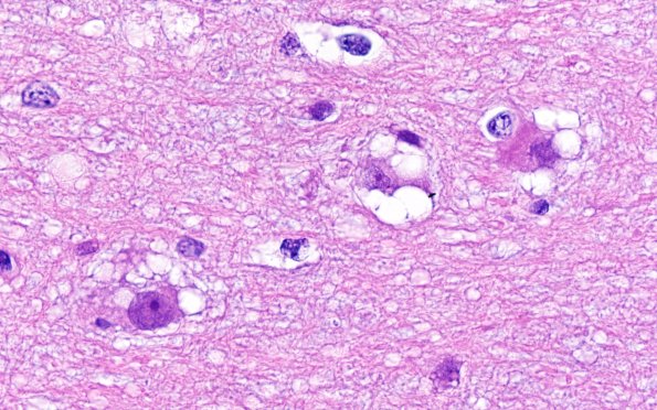 3B12MVNT (Case 3) H&E 100X 8