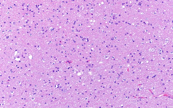 3B2 MVNT (Case 3) H&E 20X