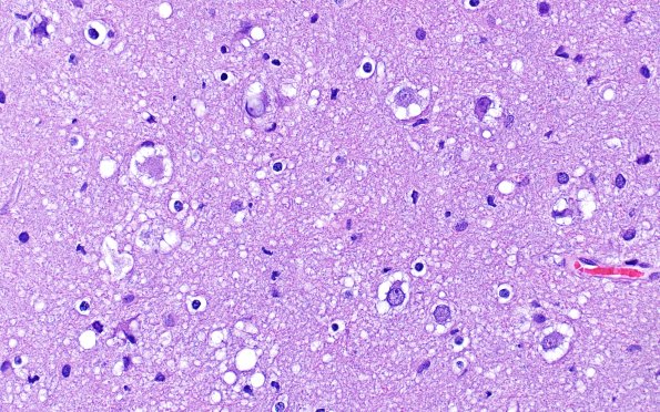 3B4 MVNT (Case 3) B H&E 40X 1