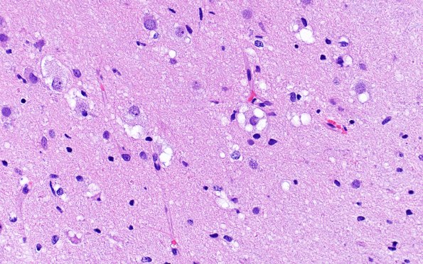 3B5A MVNT (Case 3) B1 H&E 40X