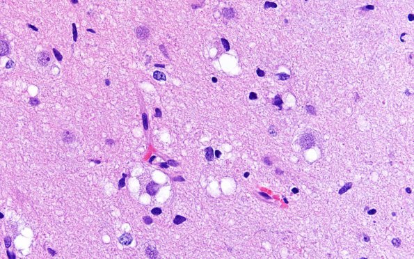 3B5B MVNT (Case 3) B1 H&E 60X