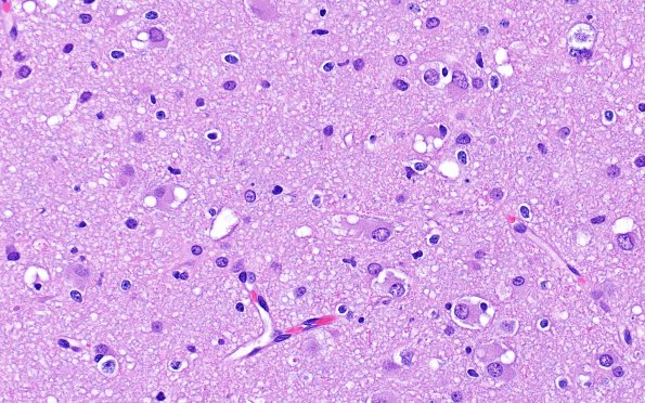 3B6 MVNT (Case 3) B6 H&E 40X 2