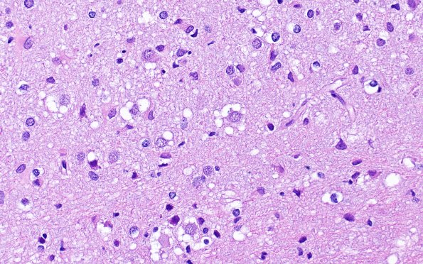 3B7MVNT (Case 3) H&E 40X 2