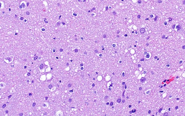 3B8 MVNT (Case 3) B6 H&E 40X 3